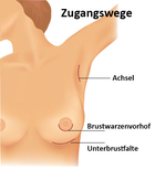 Zugangswege für Brustimplantate / Zum Vergrößern auf das Bild klicken