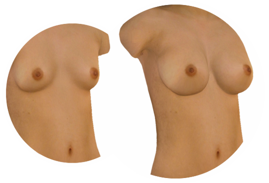 3D-Simulation Ihrer Brust-OP