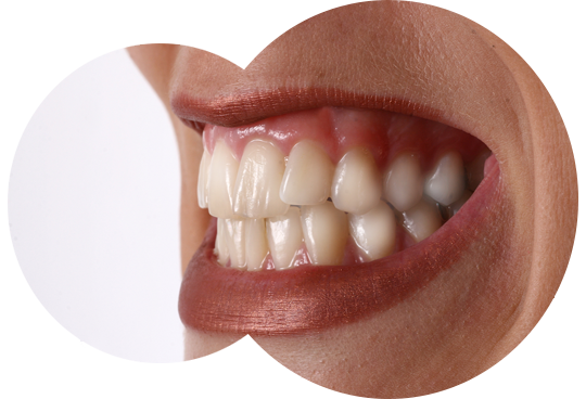 Behandlung mit Botox bei nächtlichem Zähneknirschen (Bruxismus)